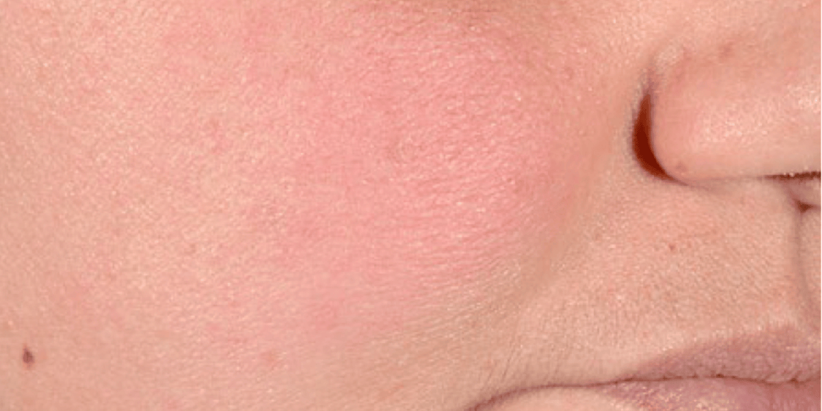Close-up of a person's cheek and nose area showing a pink, slightly red skin texture.