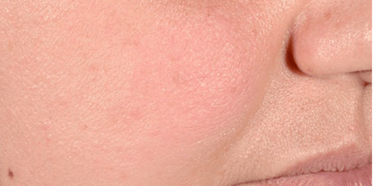 Close-up of a person's cheek and nose area showing skin texture and tone.