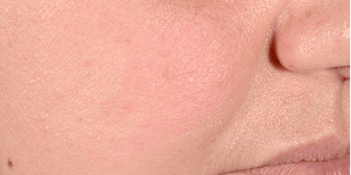 Close-up of a person's cheek and nose area showing skin texture and tone.