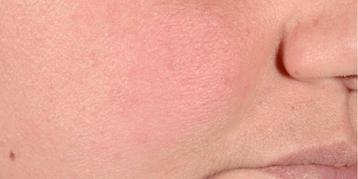 Close-up of a person's cheek and nose area showing a pink, slightly red skin texture.